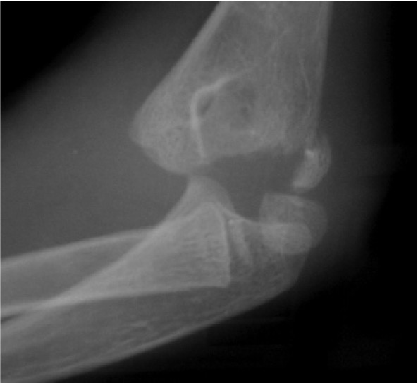 Distal Humerus Physis Separation